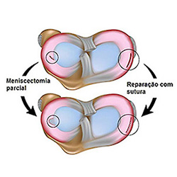 Lesões Meniscais