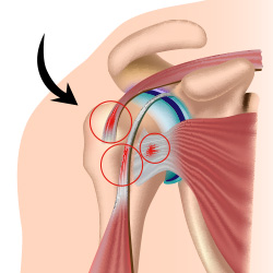 Lesão do Manguito Rotador