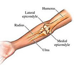 Epicondilite Lateral do Cotovelo