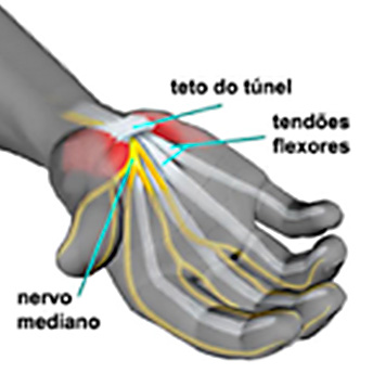 Síndrome do Túnel do Carpo